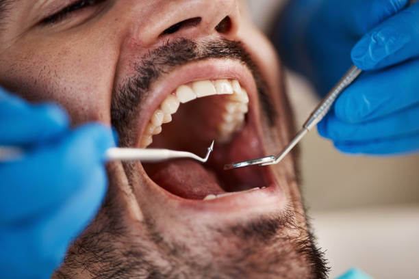 Best Chipped Tooth Repair Near Me  in Moundridge, KS
